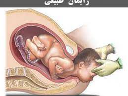  	توصيه هاي خودمراقبتي در زايمان طبيعي